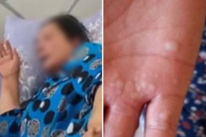 В Узбекистане опровергли случай заражения обезьяньей оспой